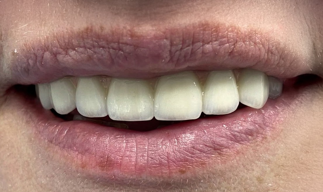 Implantology 1 after