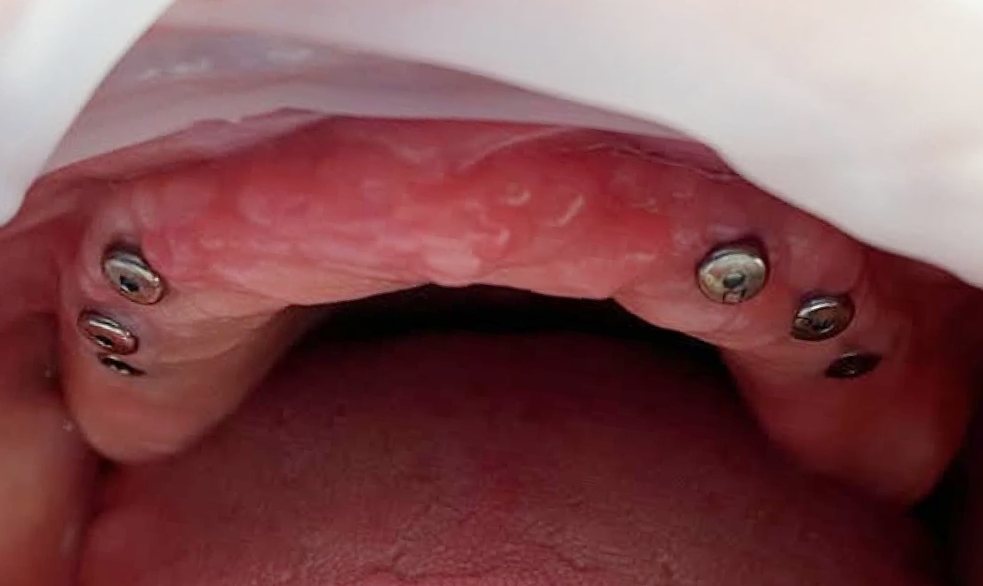 Implantology 1 before