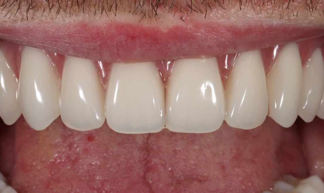 Implantology 2 after