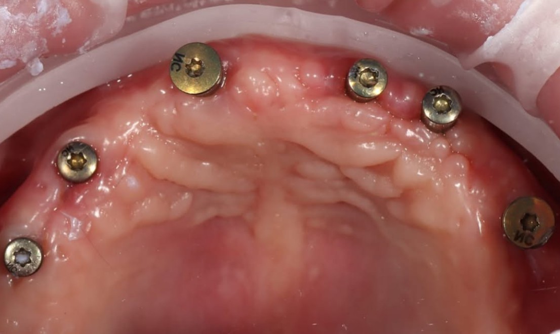 Implantology 2 before