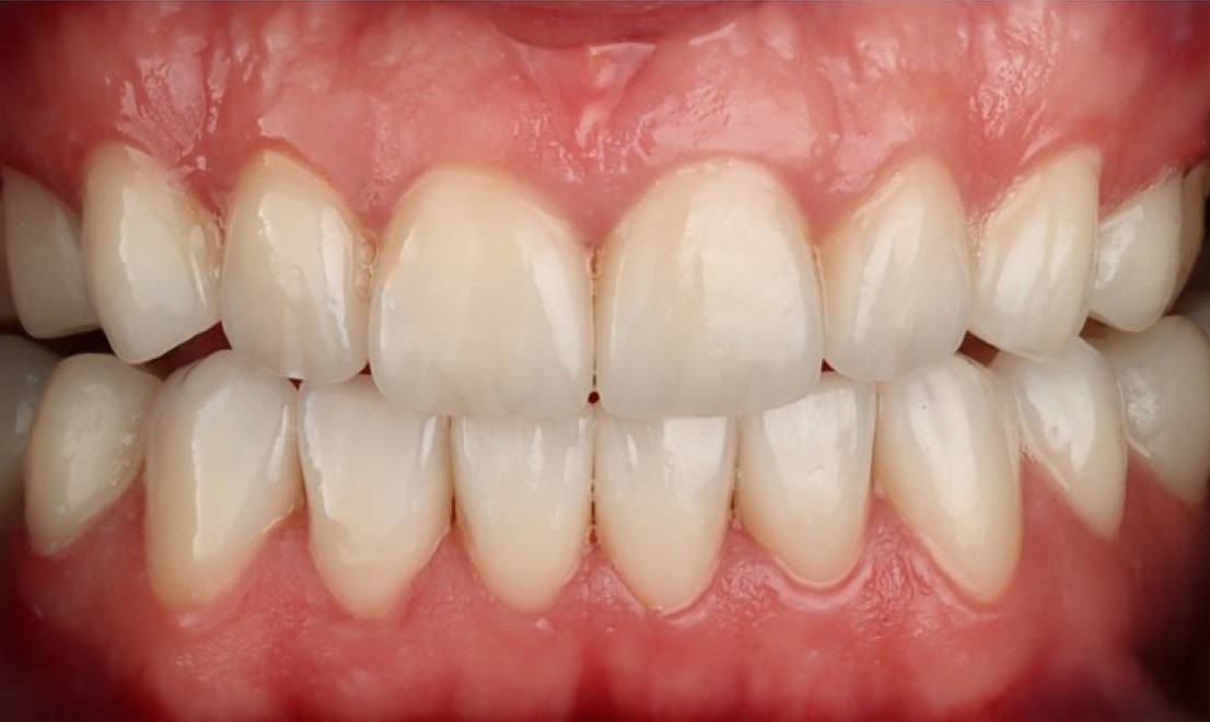 Veneers1 after