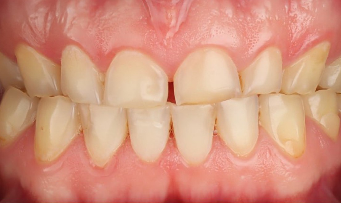 Veneers1 before