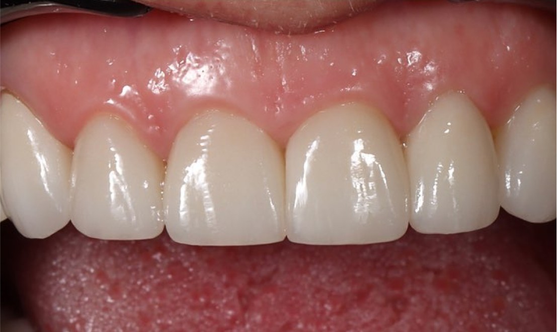Veneers2 after