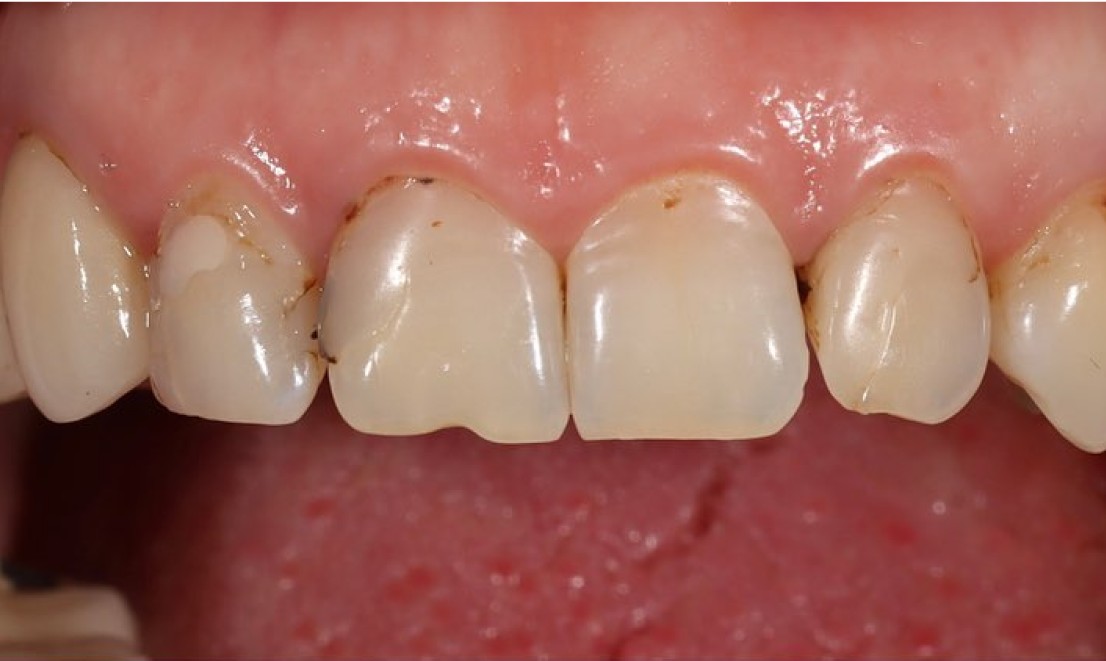 Veneers2 before