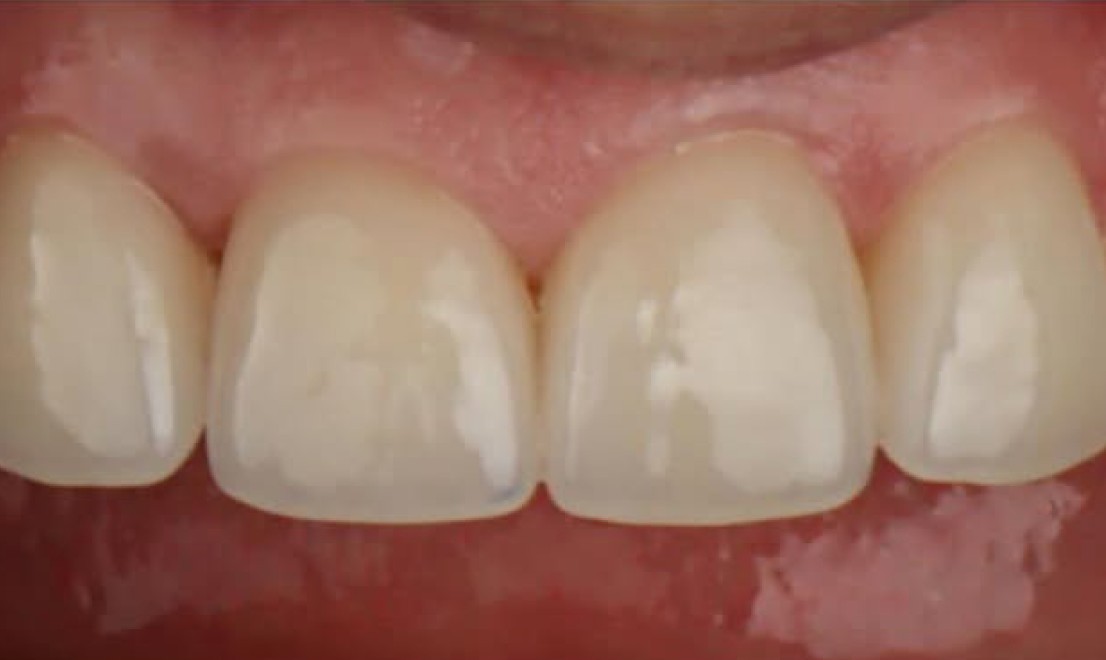 Veneers3 after