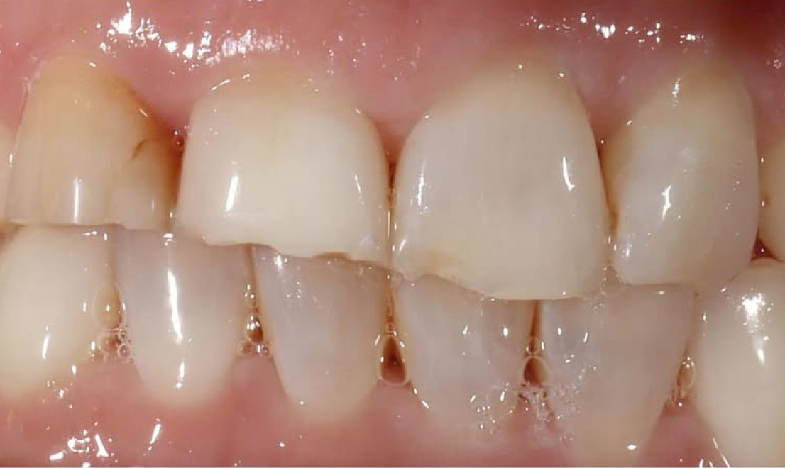 Veneers3 before