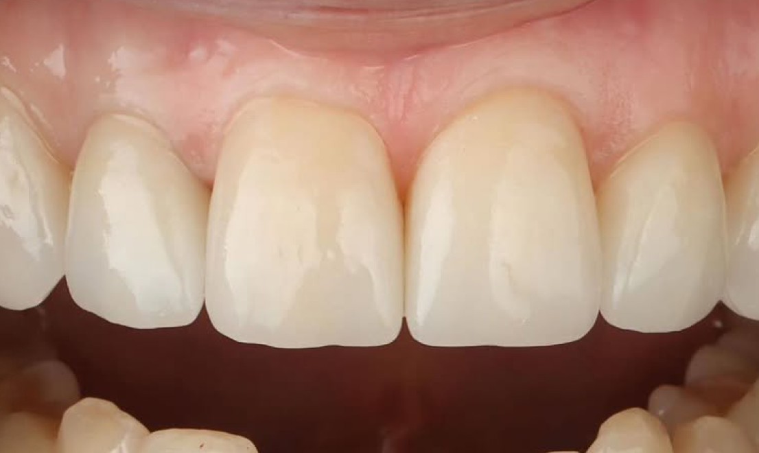 Veneers4 after
