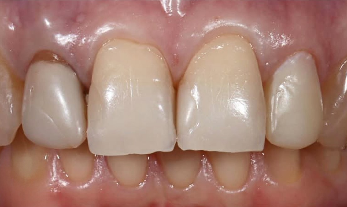 Veneers4 before