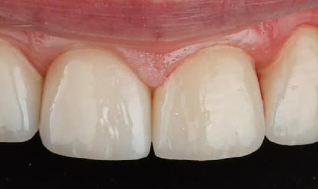 Veneers5 after
