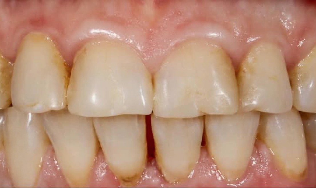 Veneers5 before