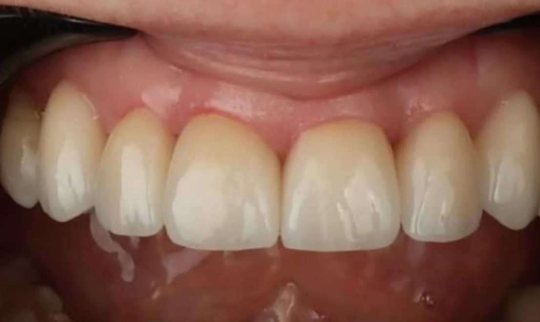 Veneers6 after
