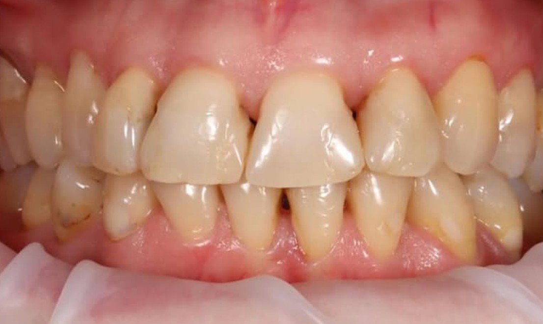 Veneers6 before