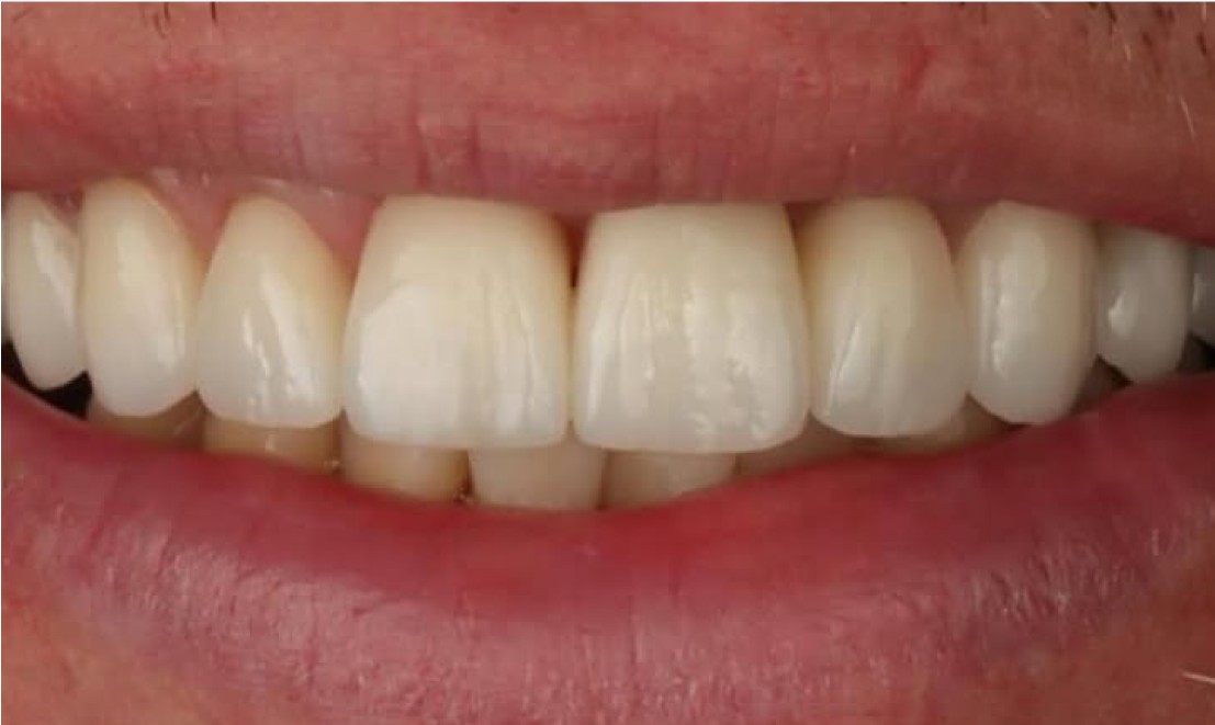Veneers7 after