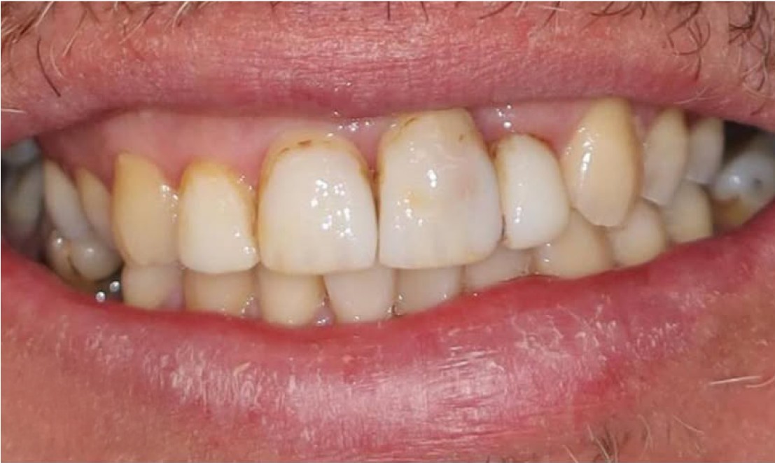 Veneers7 before