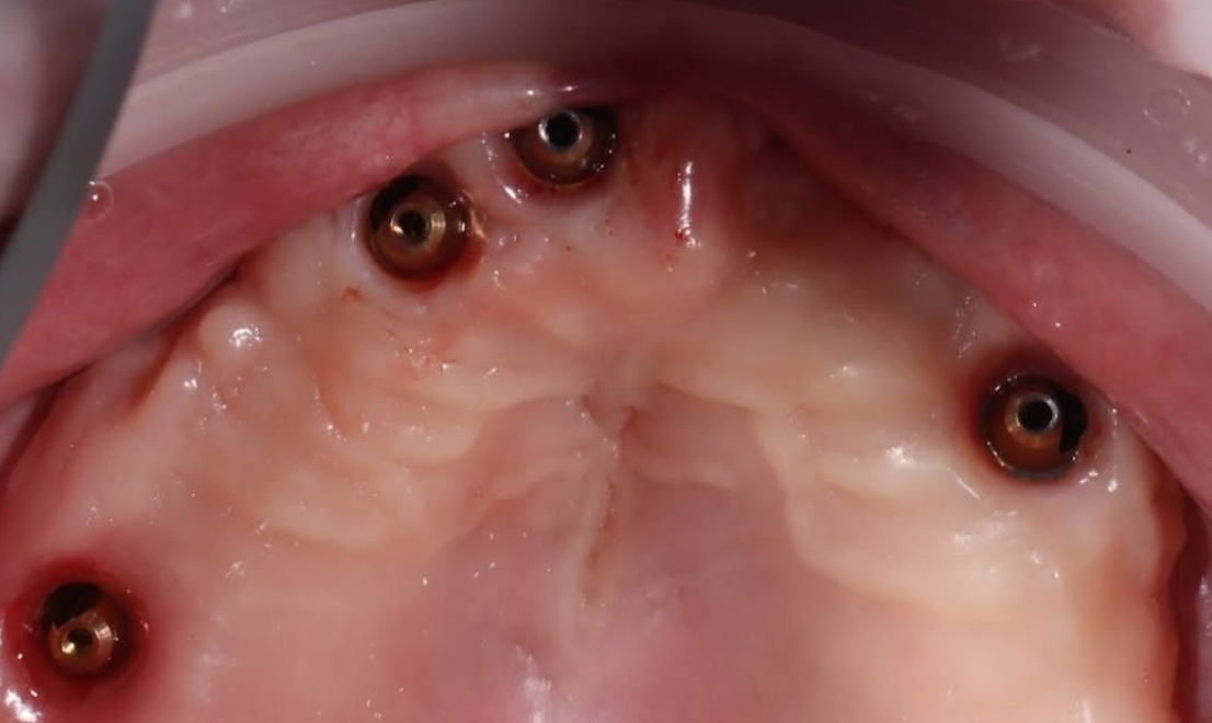 Implantology 3 before