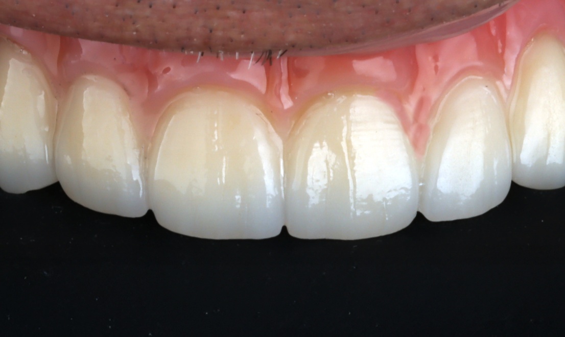 Implantology 3 after