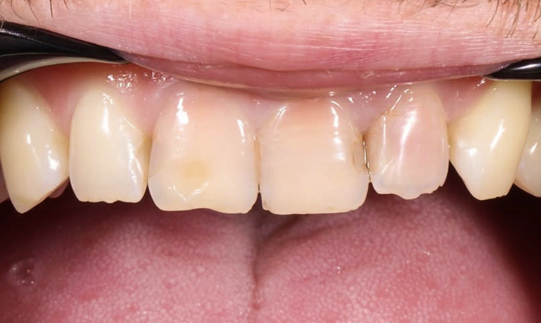 Venners 10 before