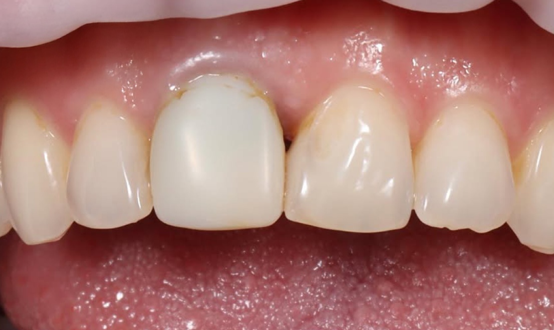 Veneers 11 before