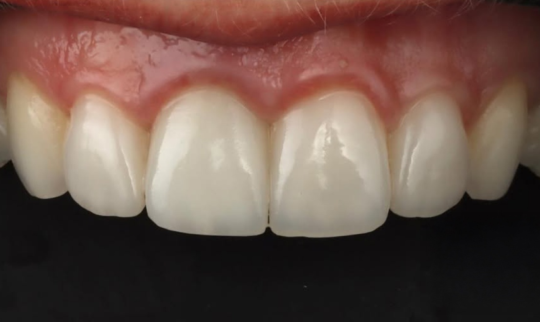 Veneers 11 after