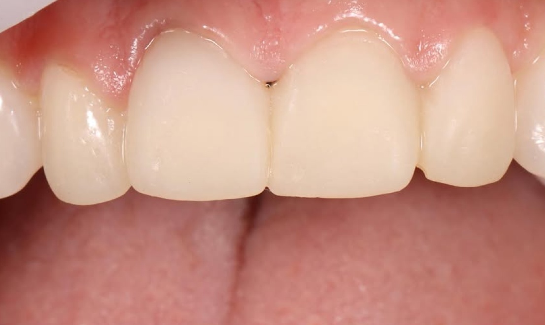Veneers 12 before
