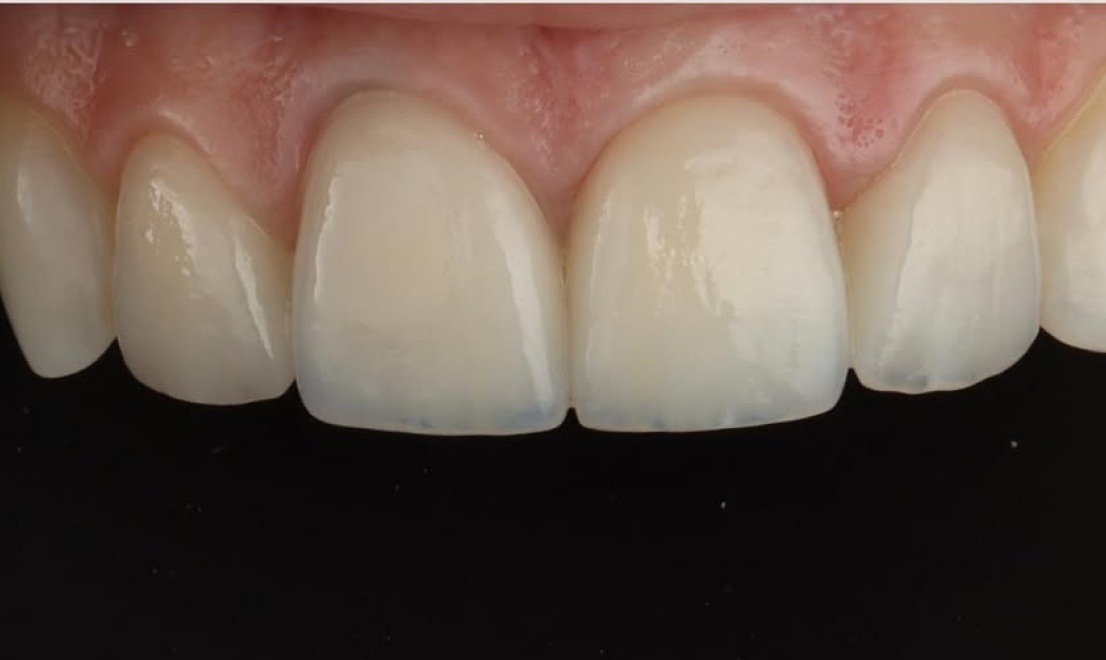 Veneers 12 after