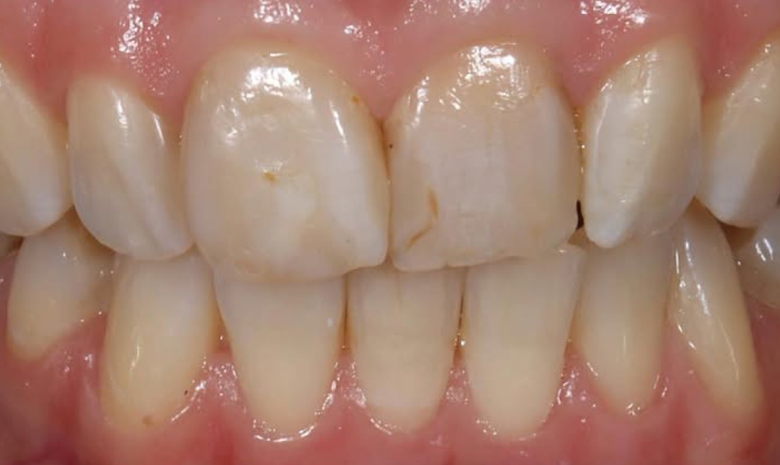 Veneers 13 before