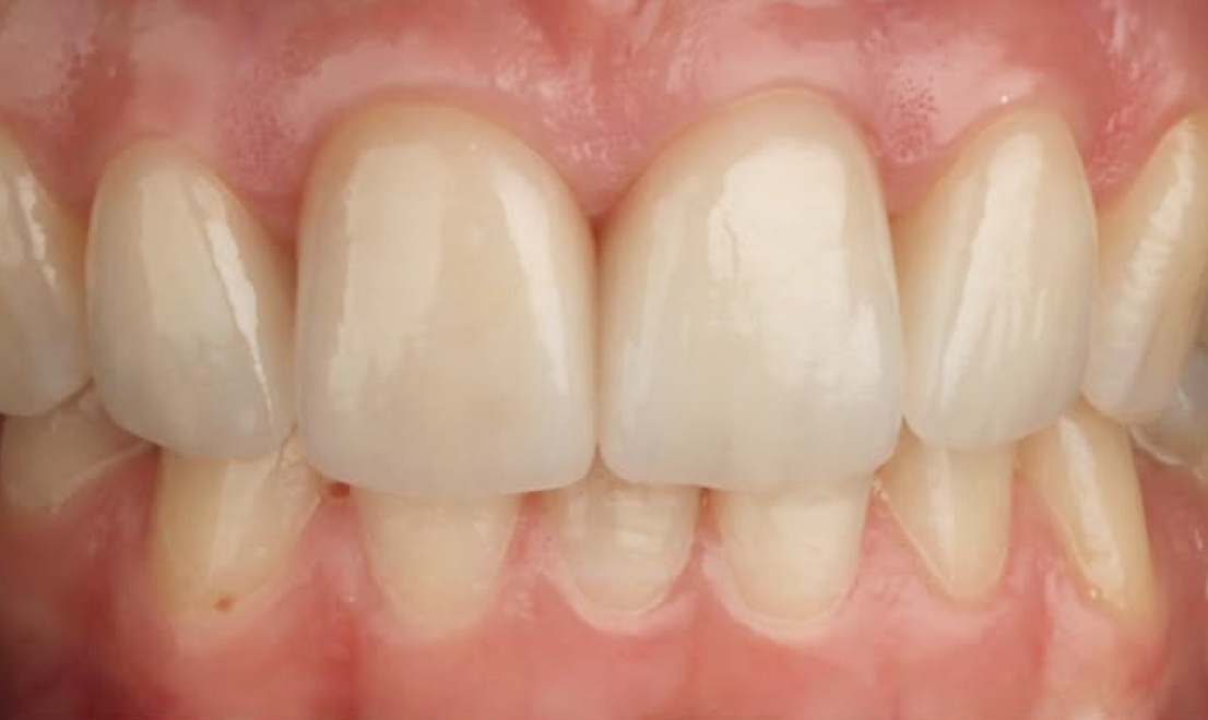 Veneers 13 after