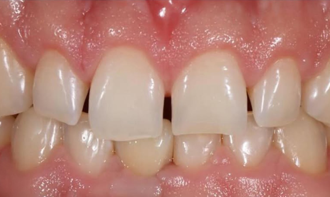 Veneers 14 before