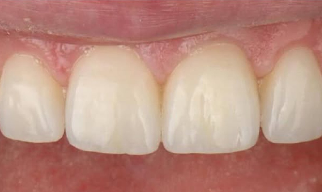 Veneers 14 after
