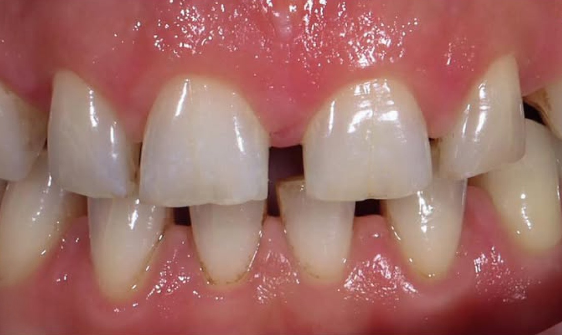 Veneers 15 before