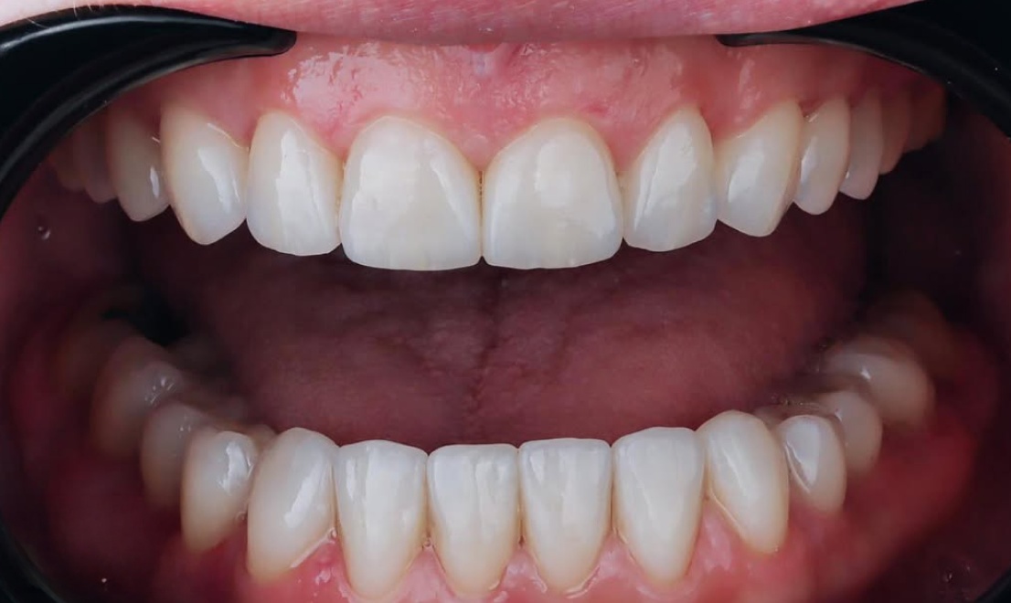 Veneers 15 after