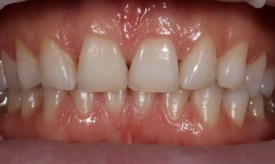 Veneers 16 before