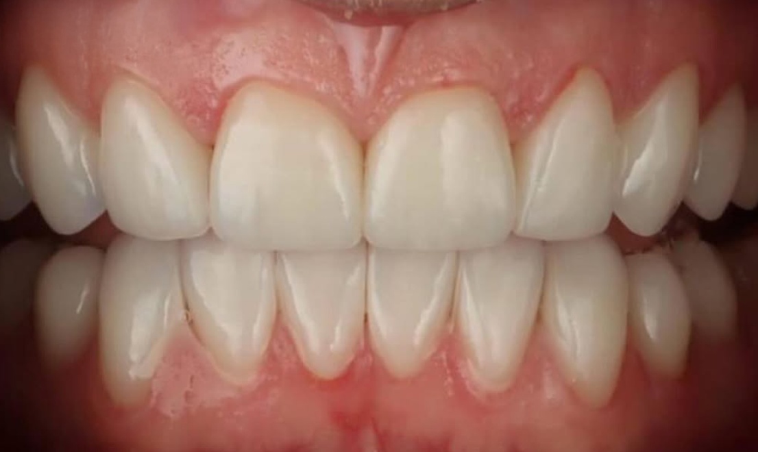 Veneers 16 after
