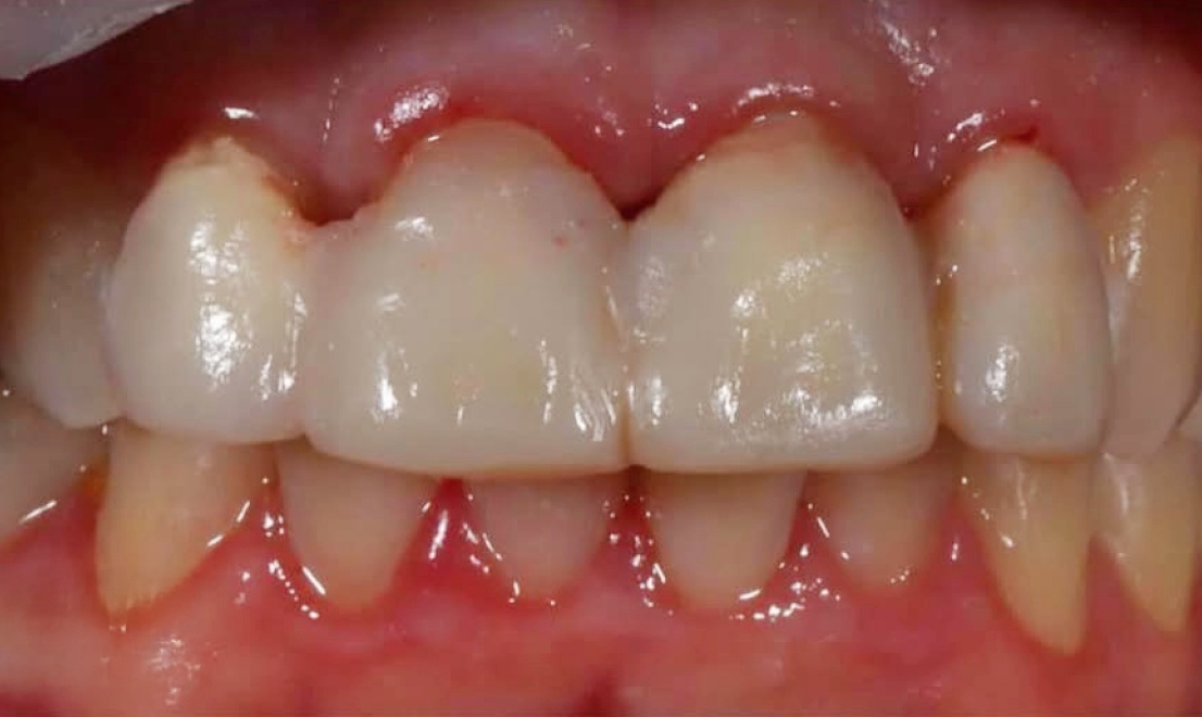 Veneers 8 before