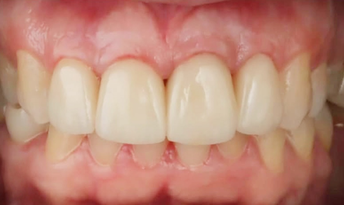 Veneers 8 after