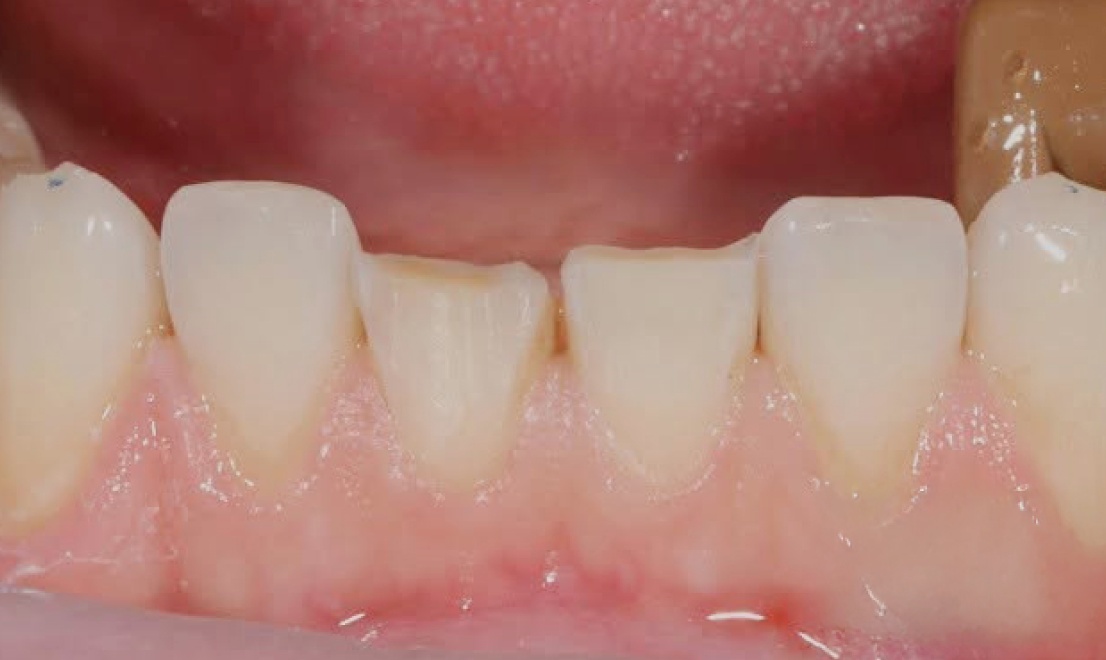Veneers 9 before
