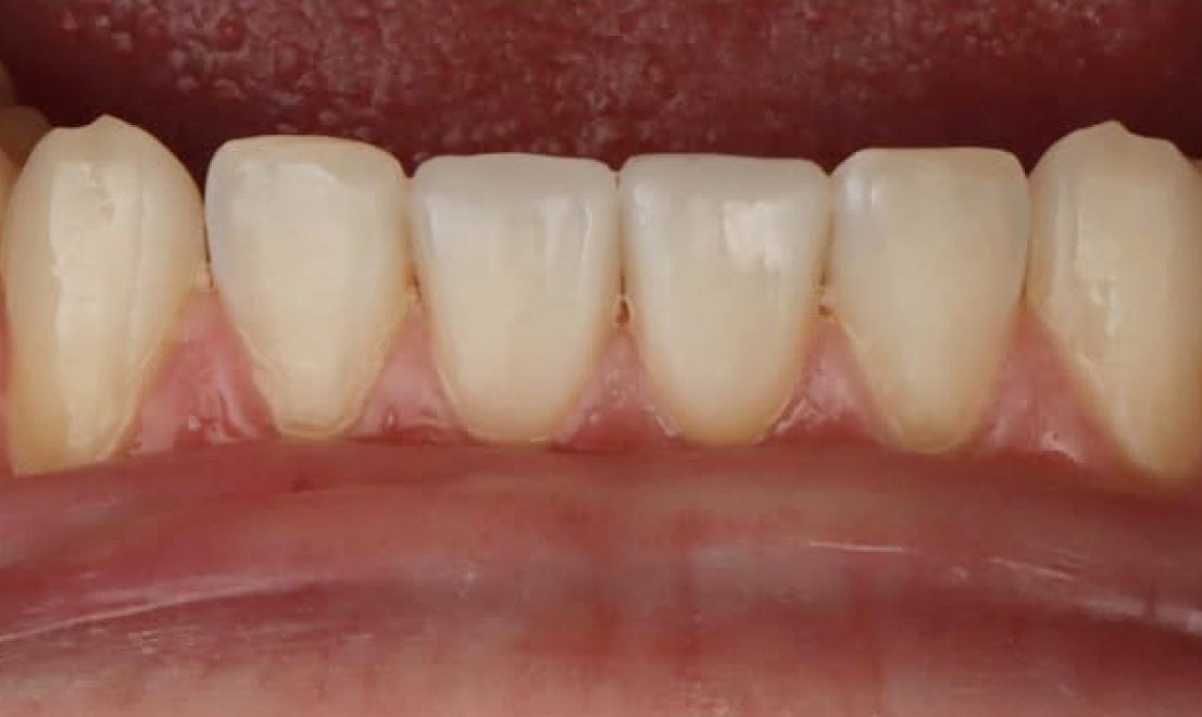 Veneers 9 after
